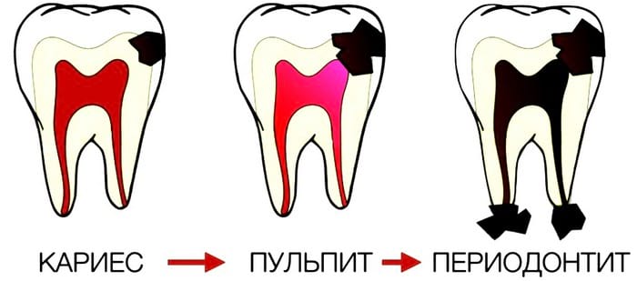что такое пульпит