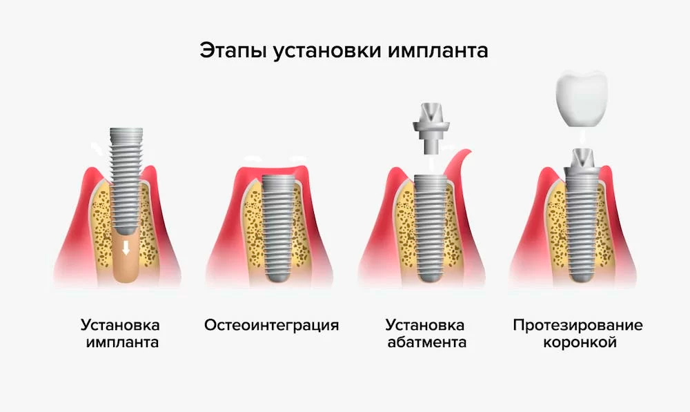 этапы установки импланта