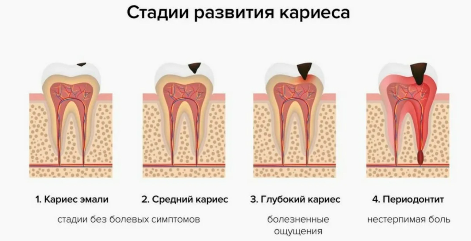 Стадии развития кариеса